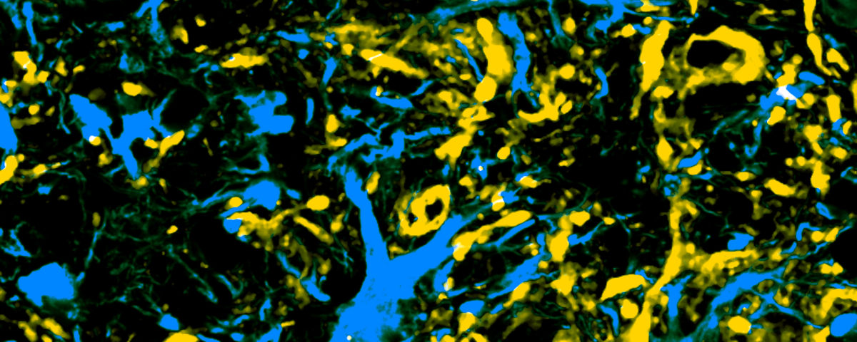 ABOVE: Astrocytes (blue) have infiltrated the interior of the spinal cord, affecting neurons (yellow) in a mouse model of amyotrophic lateral sclerosis (ALS). In the study, the researchers developed an approach to deliver a CRISPR base editing system (green) to astrocytes in order to disable the expression of a mutant gene and reduce symptoms. COLIN LIM, UNIVERSITY OF ILLINOIS Base editors, which convert one nucleotide to another without a double-strand DNA break, have the potential to treat diseases caused by mutant genes. One drawback, though, is that the DNA that encodes CRISPR base editors is long—too long to fit in the adeno-associated viruses (AAVs) most commonly used for gene therapy. In a study published in Molecular Therapy on January 13, researchers split the DNA encoding a base editor into two AAV vectors and injected them into a mouse model of inherited amyotrophic lateral sclerosis (ALS). The strategy disabled the disease-causing gene, improving the animals’ symptoms and prolonging their lives. “We’d like to be able to make gene editing tools that can fit inside an AAV vector. Unfortunately, some of the tools are so big that they can’t fit inside, so in this study, they were able to come up with a solution to that by using a split protein,” says David Segal, a biochemist at the University of California, Davis, who was not involved in the work. “It’s not the first time that that system has been used, but it’s the first time it’s been applied to this kind of base editor.” Pablo Perez-Pinera, a bioengineer at University of Illinois at Urbana-Champaign, and colleagues developed a strategy to split the base editor into two chunks. In a study published in 2019, they generated two different AAV vectors, each containing a portion of coding DNA for an adenine-to-thymine base editor. They also included sequences encoding so-called inteins—short peptides that when they are expressed within proteins stick together and cleave themselves out, a bit like introns in RNA. The researchers built the inteins into the vectors such that when the inteins produced by the two vectors dimerized, bringing the two base editor parts together, and then excised themselves, they left behind a full-length, functional base editor. When Perez-Pinera told Thomas Gaj, also a bioengineer at the University of Illinois at Urbana-Champaign, about the strategy, Gaj tells The Scientist, they immediately set out to test it in a mouse model of ALS. The transgenic mice have about 25 copies of the human gene, superoxide dismutase 1 (SOD1), with mutations that cause ALS in people. The animals display motor neuron loss and muscle atrophy, plus their neurons accumulate inclusions—dense spots in the gray and white matter of their spinal cords that include SOD1 protein—before dying at about four months of age on average. The symptoms and life expectancy in the 20 percent of ALS patients with mutations in SOD1 vary based on which mutation they have, but most have muscle weakness and motor neuron death, as well as inclusions containing SOD1 protein. Instead of using the adenine-to-thymine base editor, the researchers developed a cytosine-to-thymine converter using the coding sequence of Streptococcus pyogenes Cas9 and a guide RNA that targets both wild type and mutant human SOD1 to create an early stop codon. This doesn’t affect the mouse SOD1. In human cells, the split base editor seemed to be even more efficient than when the editor was transfected at full length, hitting about 29 percent of the target sites, compared to the full-length editor’s 19 percent. Next the authors packaged their split base editor into two AAV backbones and injected them or a control AAV into the animals’ lumbar cerebrospinal fluid when they were around two months old. The vectors ended up primarily in astrocytes, as well as in neurons and microglia. While the researchers didn’t see a difference in symptom onset at around three months, the mice that received the base editor maintained their weight and lived about 10 percent longer than controls. The treated mice also had fewer SOD1-positive inclusions and healthier motor neurons. In this cross section of the spinal cord of a mouse model of amyotrophic lateral sclerosis (ALS), researchers delivered a CRISPR base editing system (yellow) to astrocytes (red) in order to disable the expression of a mutant gene and reduce symptoms.